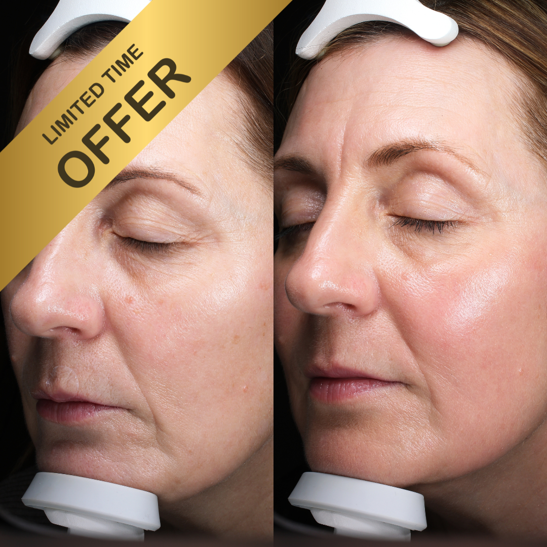 20% OFF 1x Halo - Face & Neck