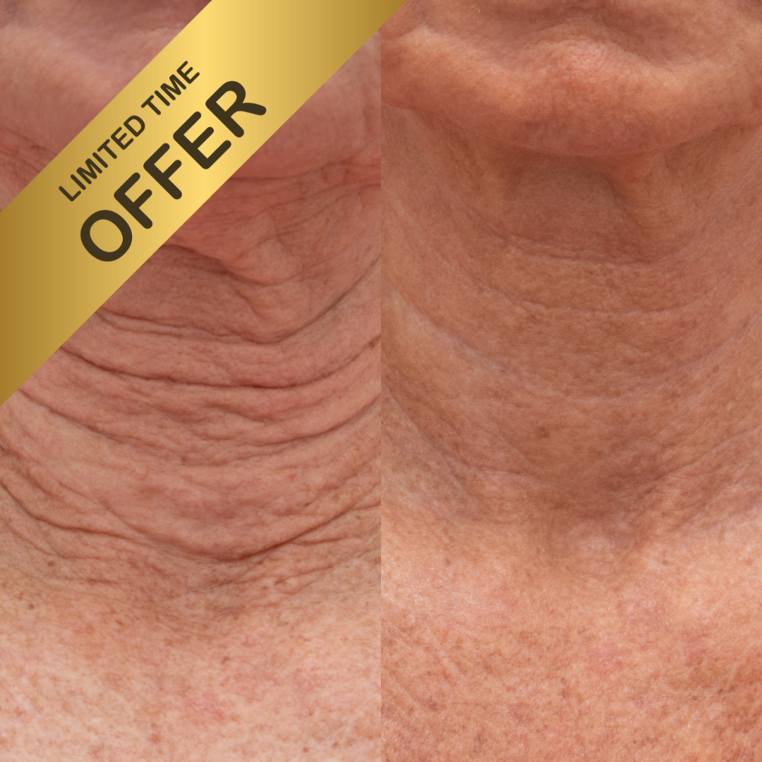 20% OFF 2x Halo Neck