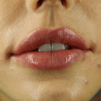 Treatment sample