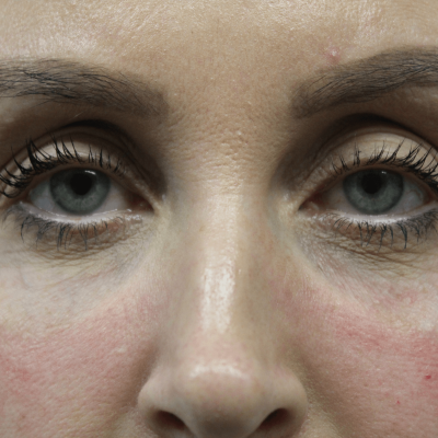Treatment sample