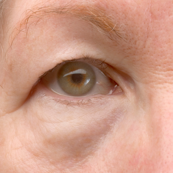 Blepharoplasty - Eyelid Surgery